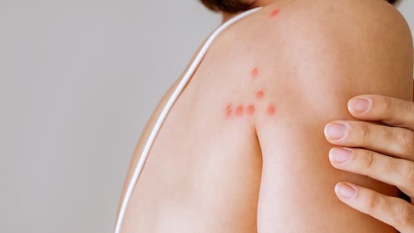 A woman with her shoulder bitten by a bedbug